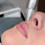 Neinvazívne prirodzené zväžšenie pier laserom LipLase